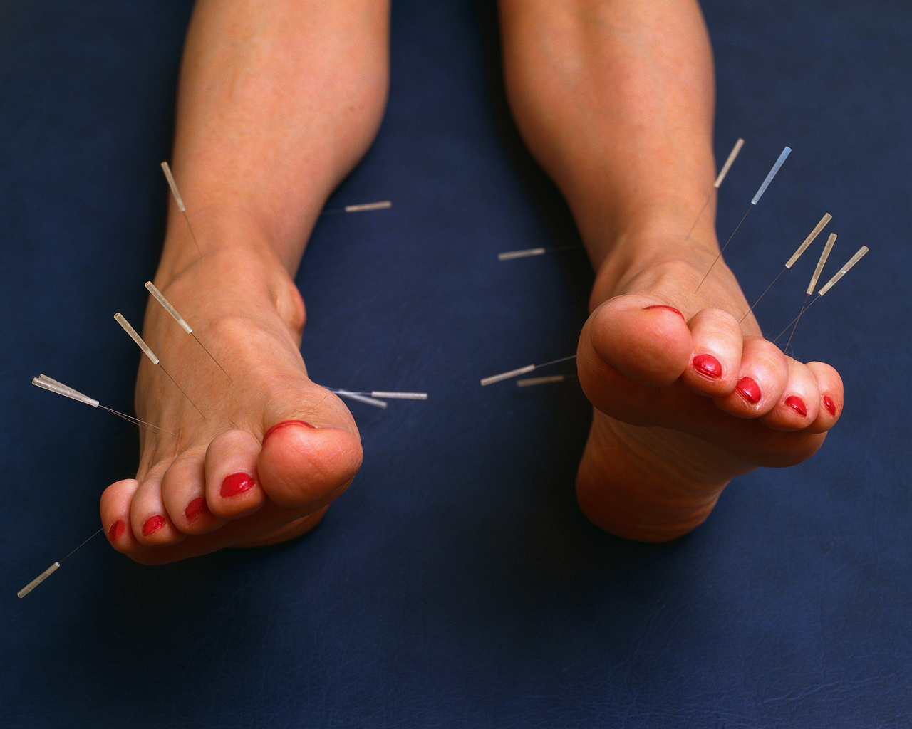 Acupuncture Needles Sticking Out from Feet