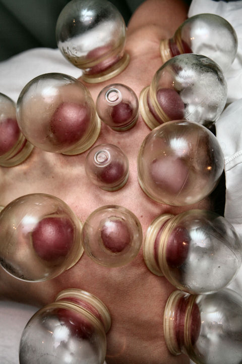 cupping-glass-21
